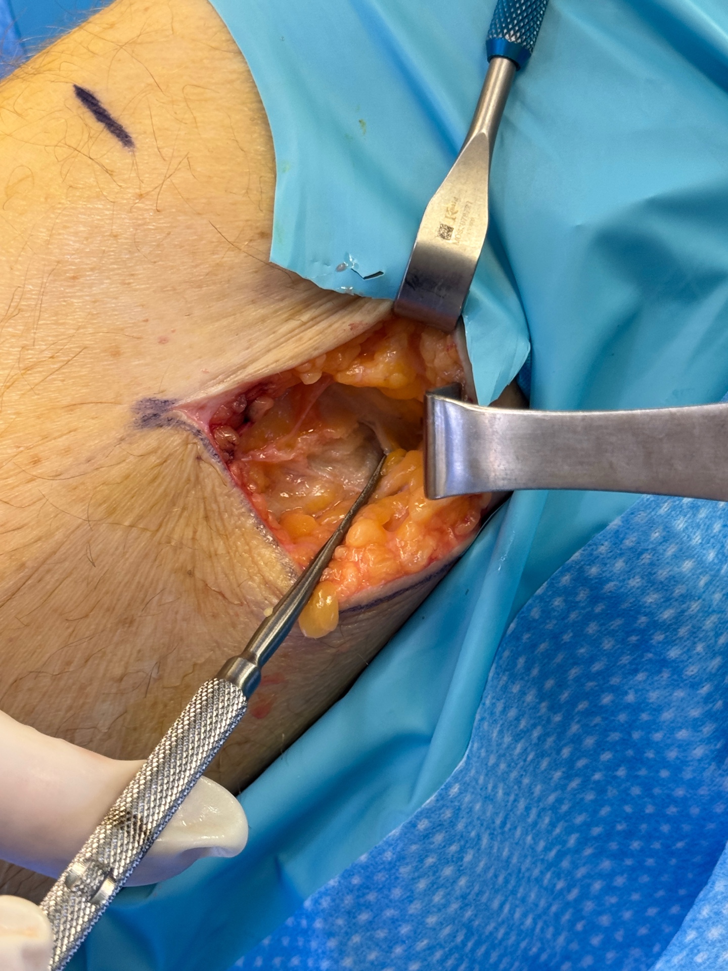 Initial Incision & Exposure