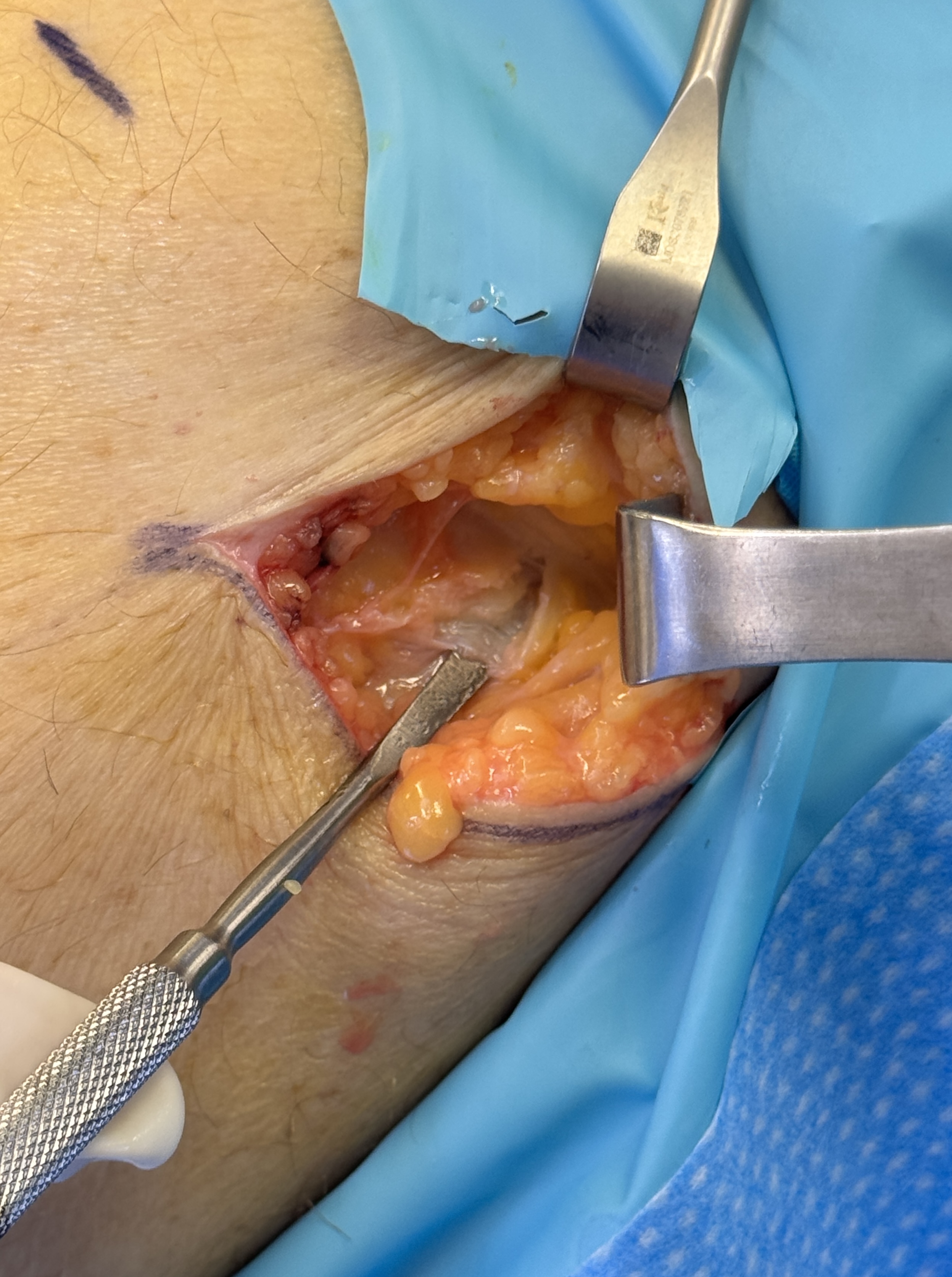 Scar Tissue Encountered