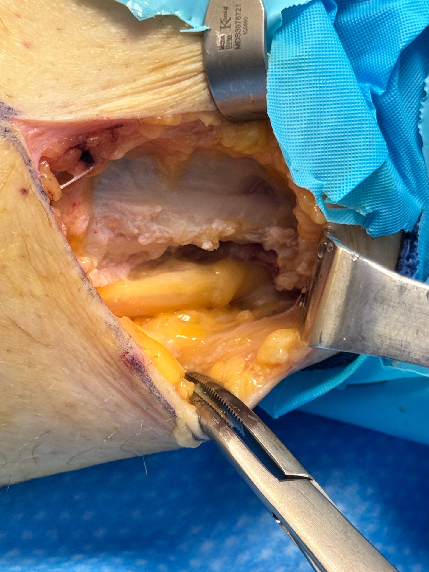 Neurolysis — Nerve Freed