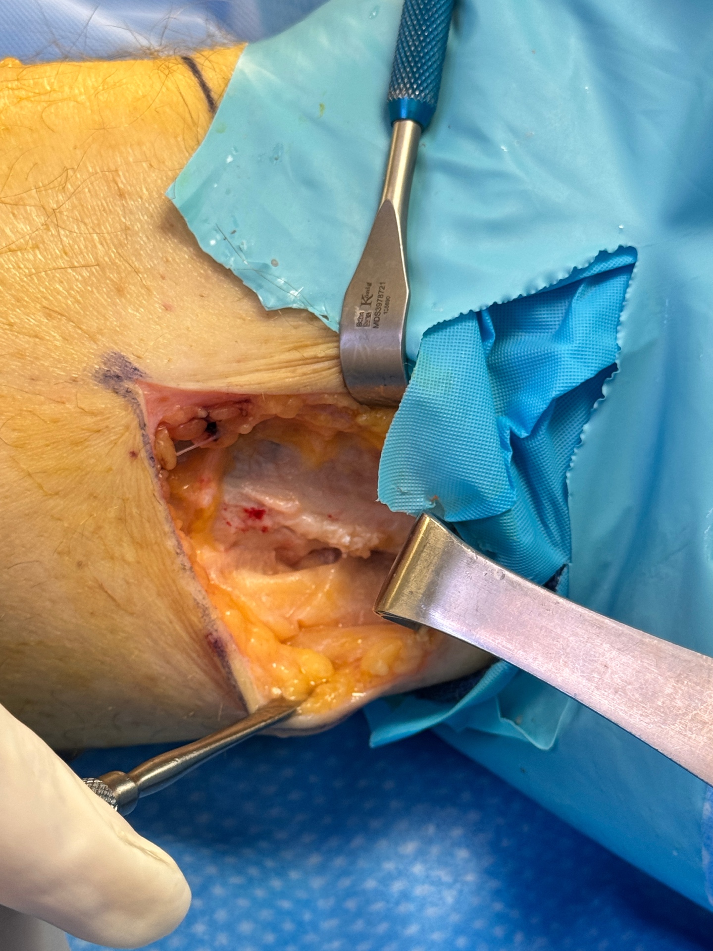 Porcine Graft Applied