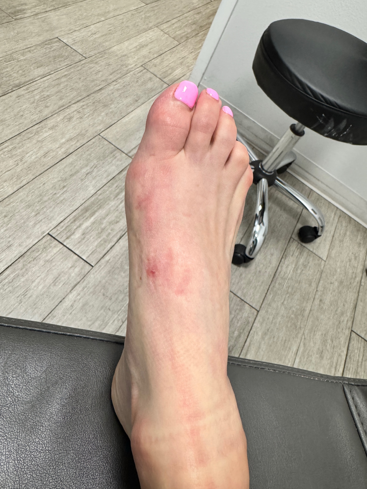 Post-operative bunion surgery result — dorsal view showing minimal scarring