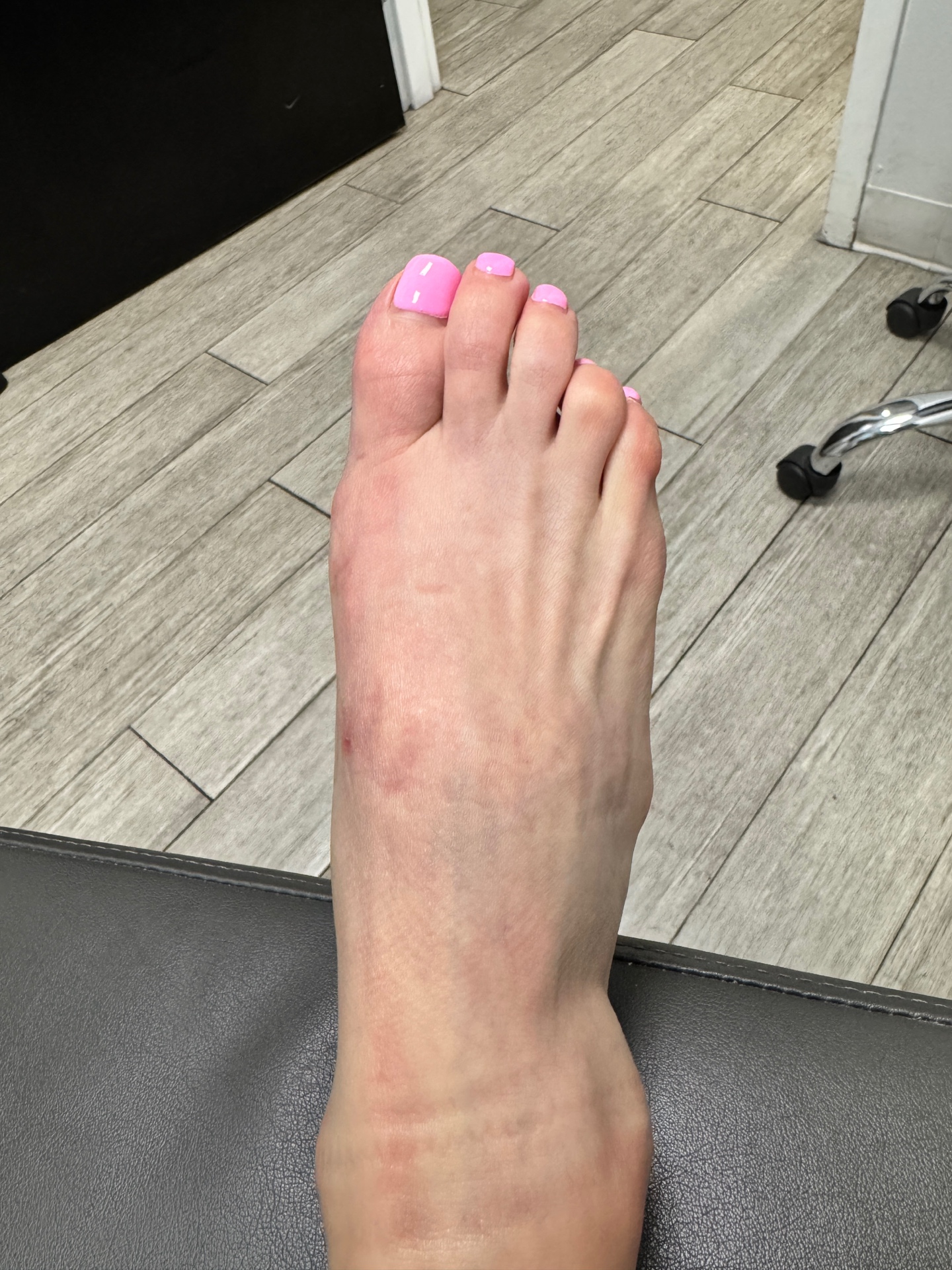 Post-operative bunion surgery result — medial view showing minimal scarring
