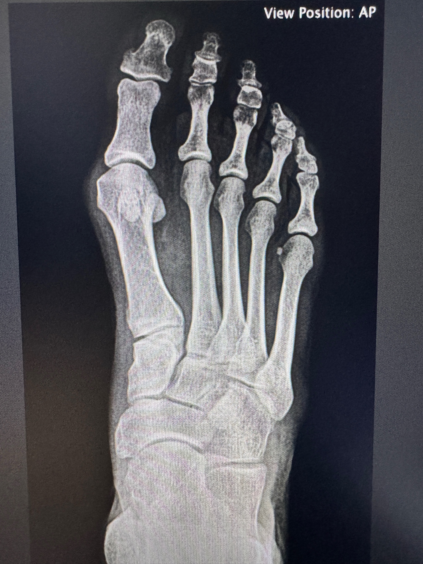 Bunion X-ray before minimally invasive surgery