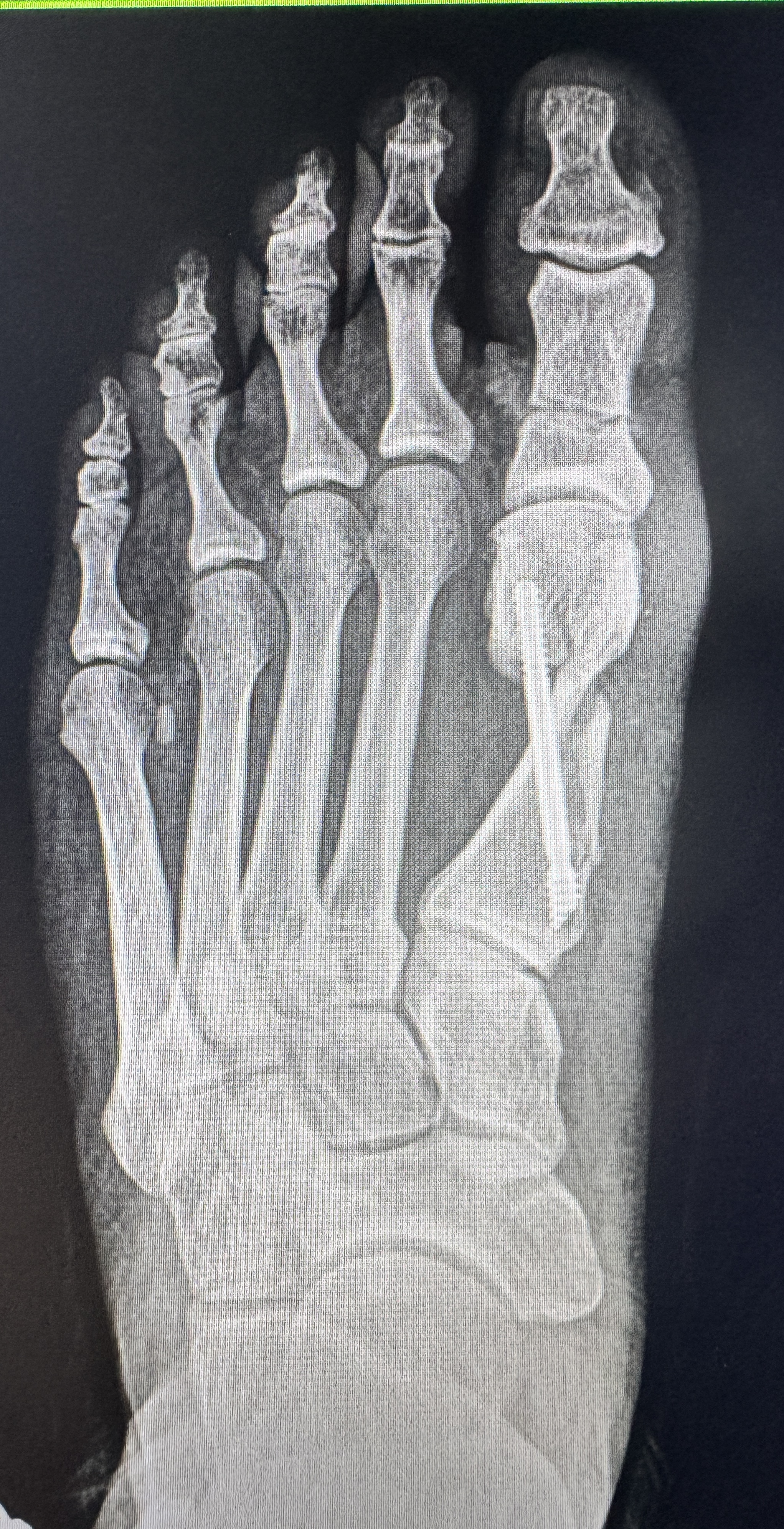 After X-ray — second case showing corrected alignment after minimally invasive bunion surgery