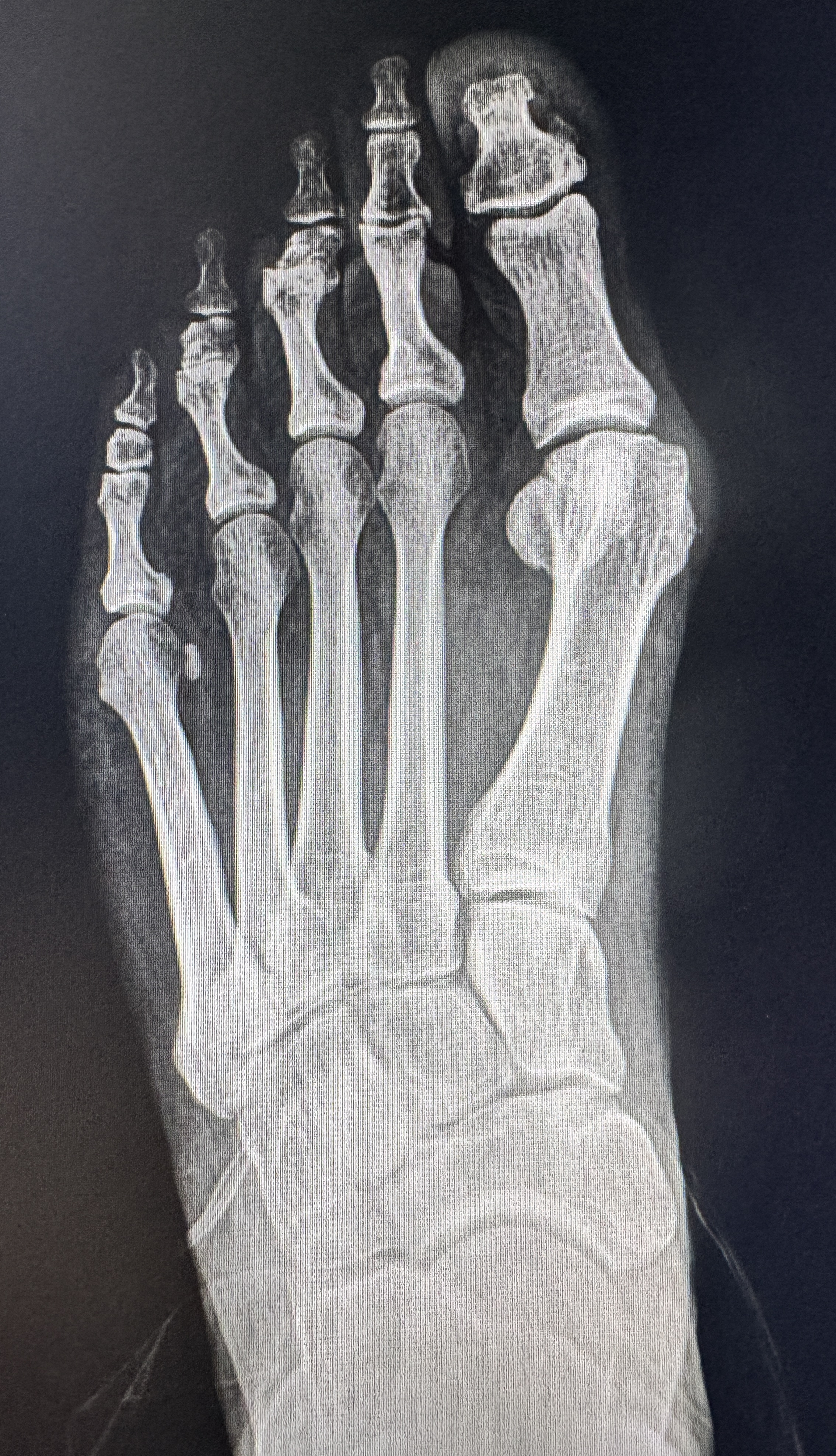 Before X-ray — second case showing severe bunion deformity