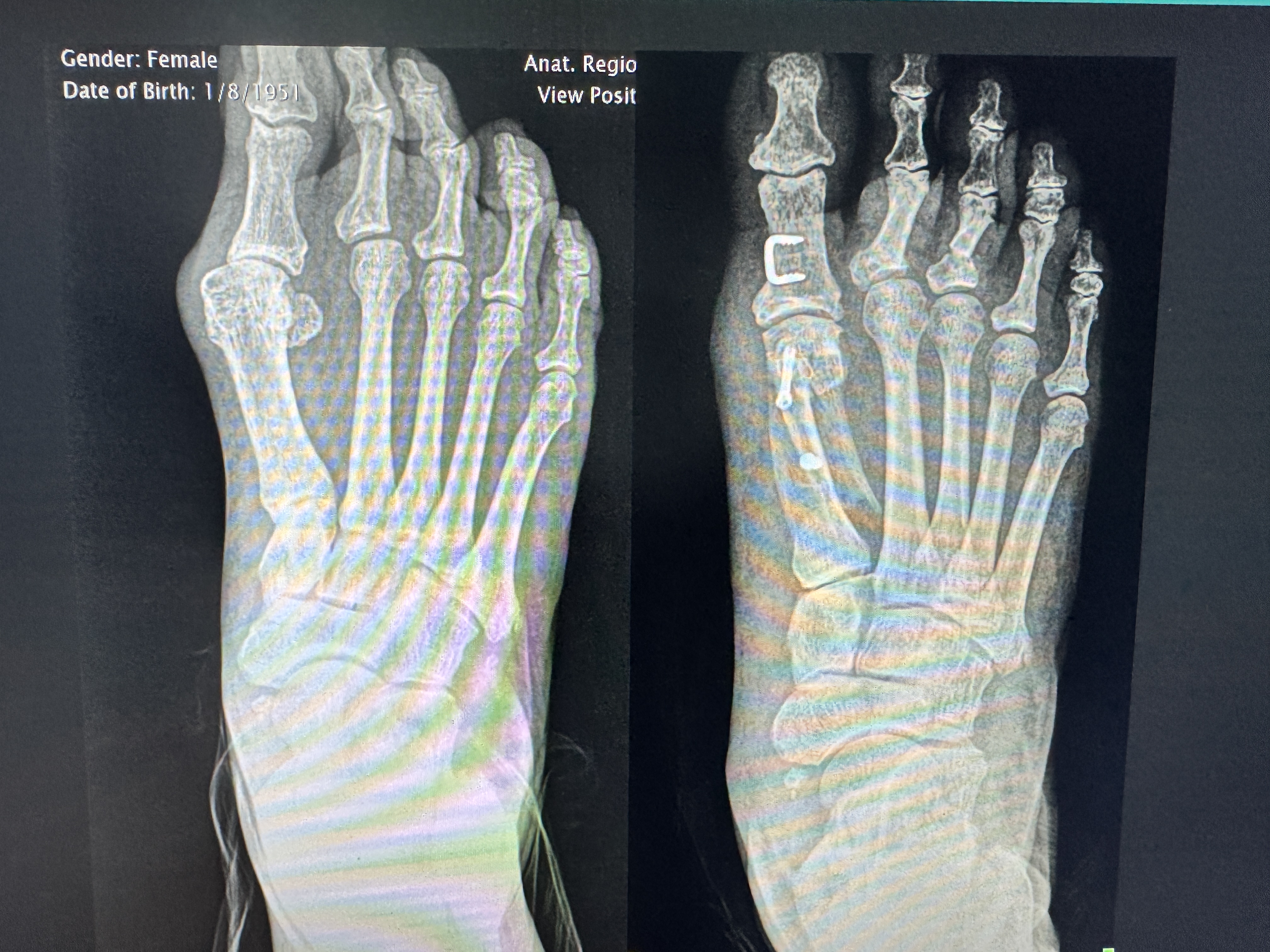 Side-by-side X-rays showing bunion deformity before and after minimally invasive correction with hardware