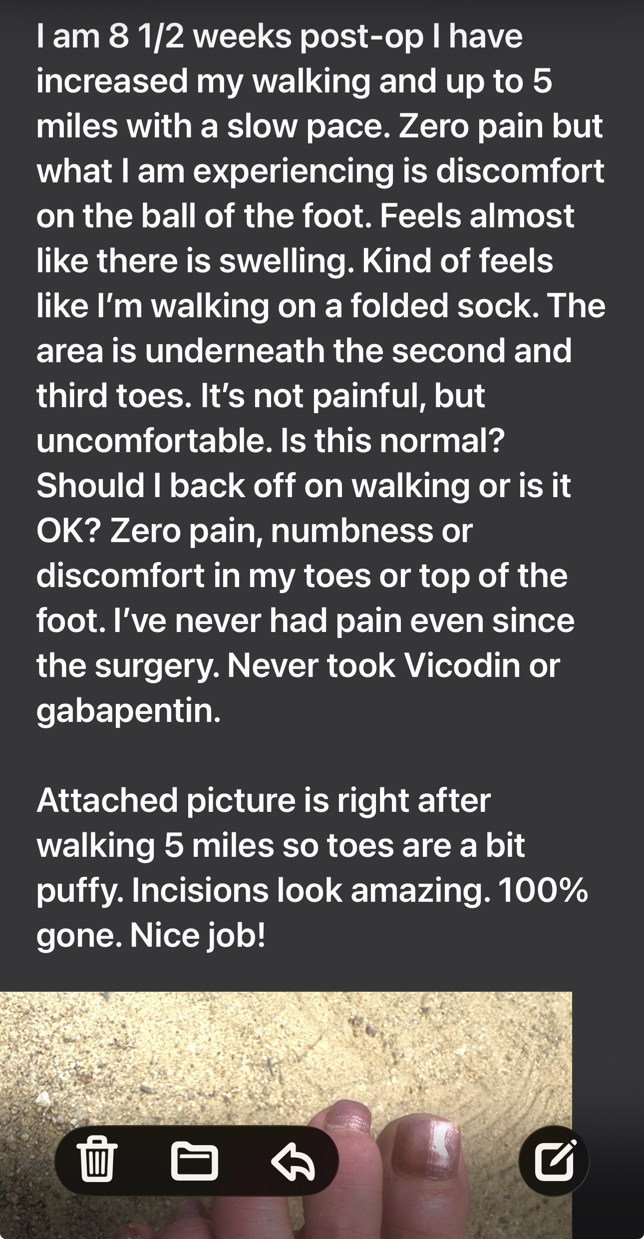 Patient foot 8.5 weeks after Morton's nerve decompression surgery — walking 5 miles pain-free