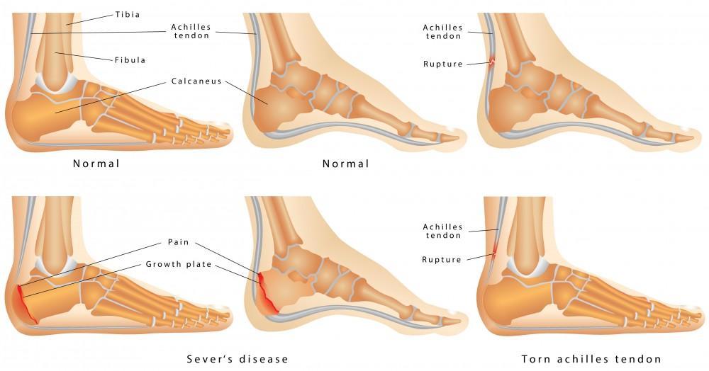Achilles tendon anatomy and injury types