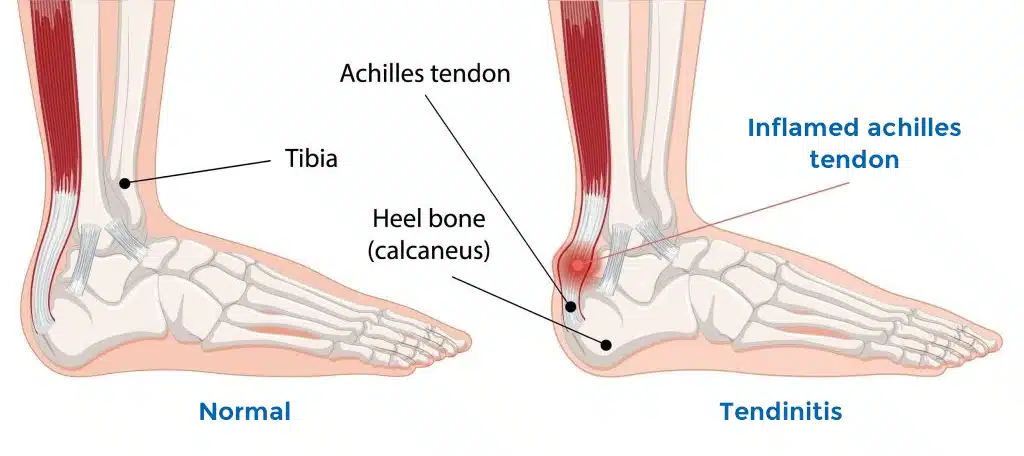 Achilles tendonitis treatment Las Vegas