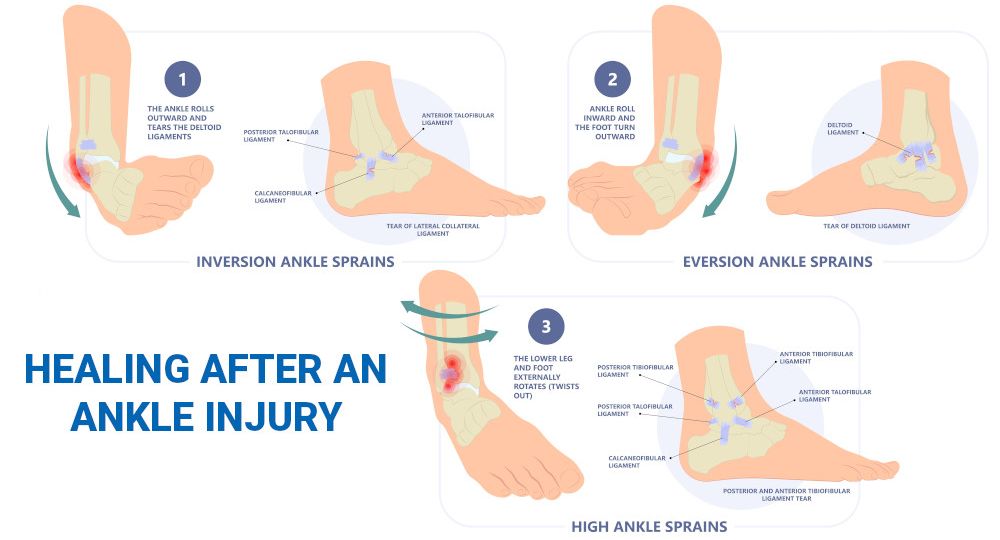 bpc 157 sprained ankle How to tape your ankle main image 1