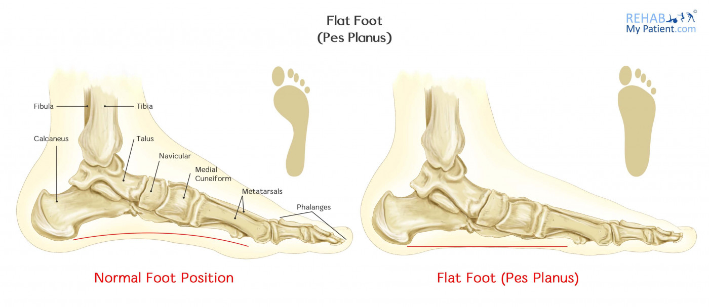 Adult flat feet arch collapse anatomy