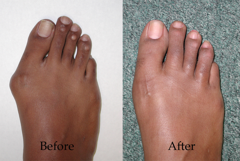 Hammertoe before and after surgical correction