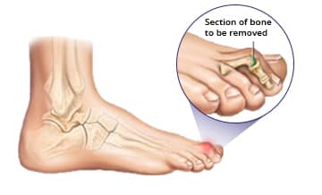 Minimally invasive hammertoe surgery procedure