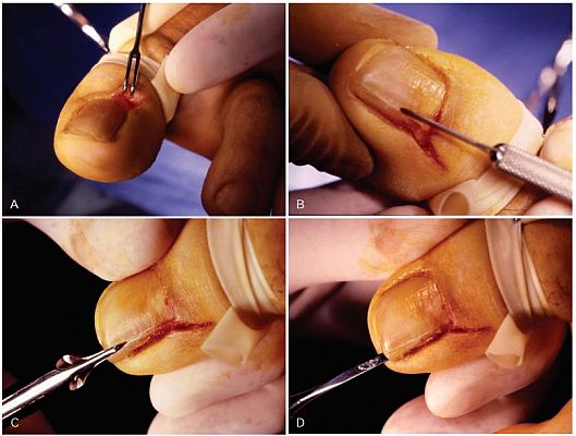 Ingrown toenail treatment procedure