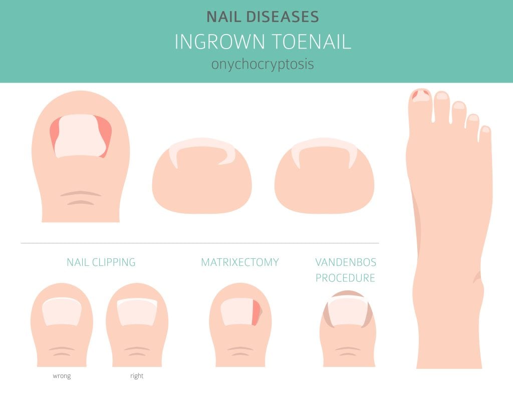 Ingrown toenail matrixectomy procedure