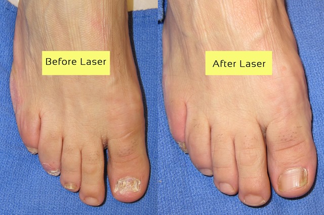 Before & After Laser