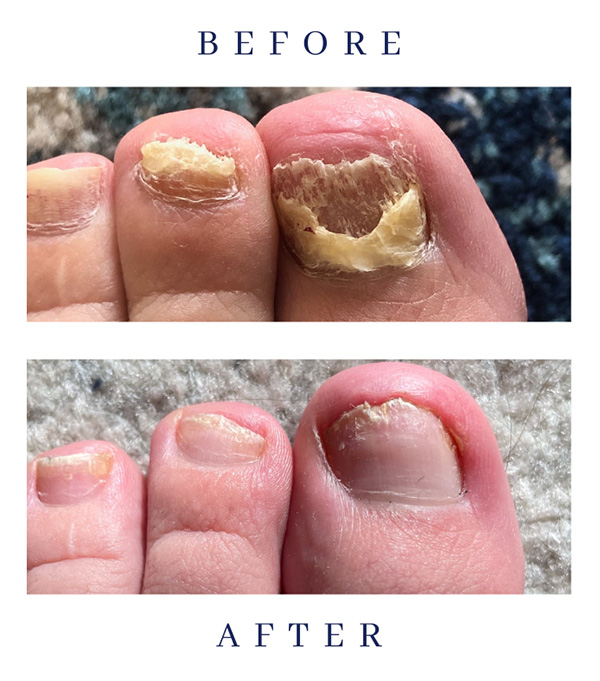 Before & After — Class IV Laser Treatment